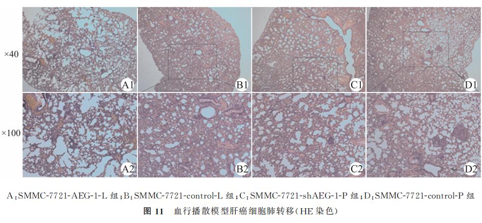 AEG-1促进肝癌生长与定向肺转移的作用与机制研究（四）